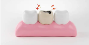 MyDentist dental implants Adelaide